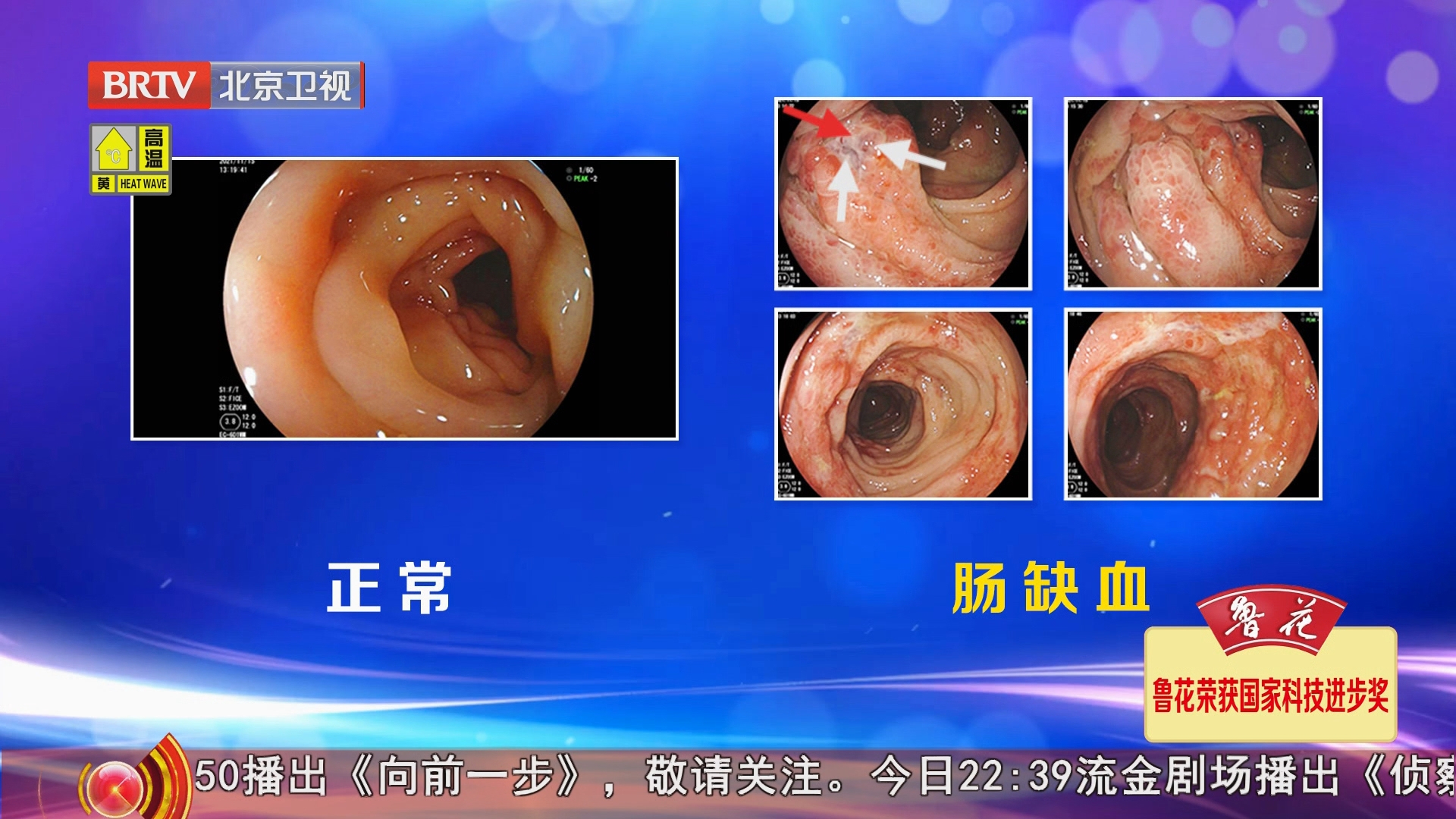 《养生堂》20240618夏季警惕凶险的“肠中风”! 《养生堂》20240618夏季警惕凶险的“肠中风”!