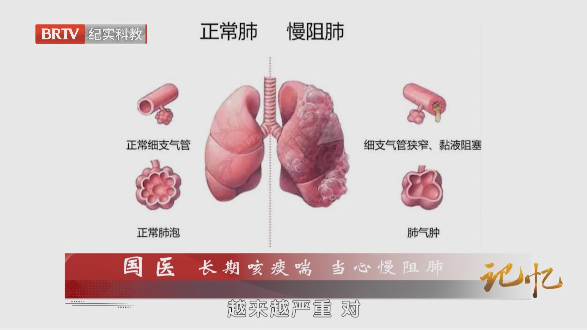 《记忆》20261009国医 长期咳痰喘 当心慢阻肺 《记忆》20261009国医 长期咳痰喘 当心慢阻肺