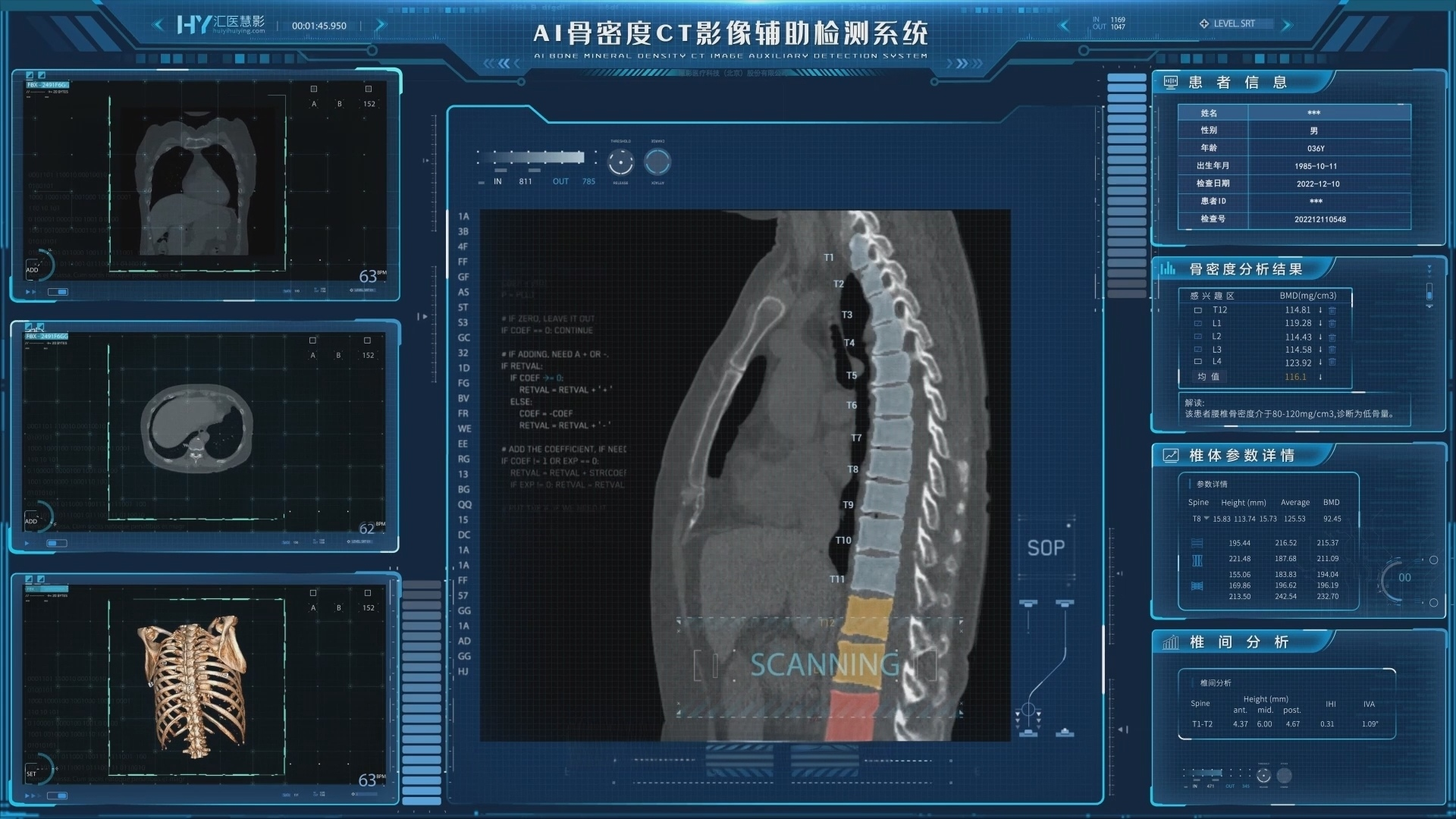 一次CT，多项筛查！汇医慧影AI一检多筛，开启影像诊断新范式