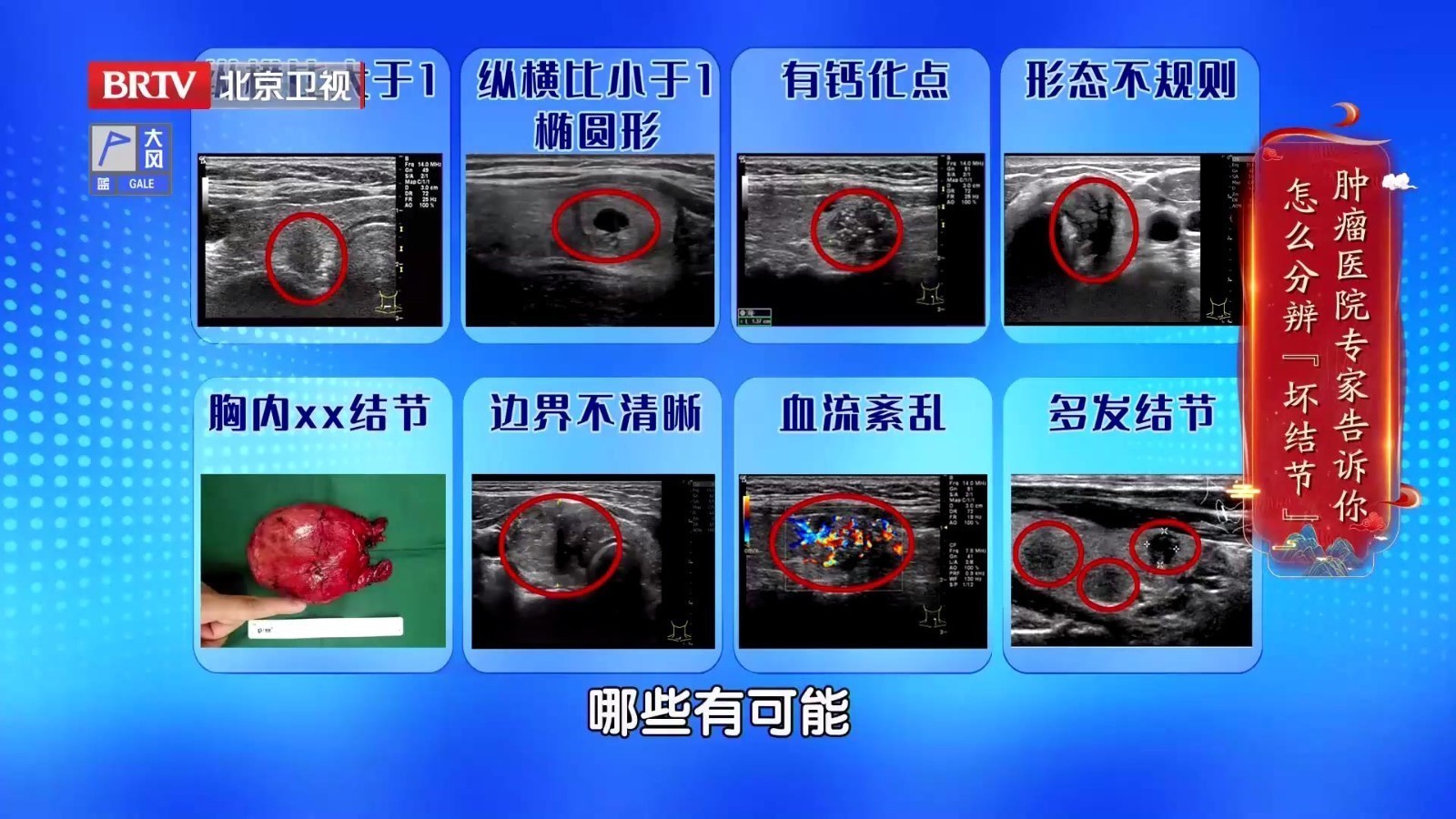 有钙化点、椭圆形……八种不同形态的甲状腺结节，谁可能是恶性？