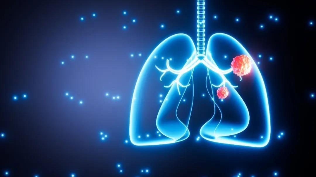 肺癌成中国女性第一大癌症 身体给出“警示”不要忽视
