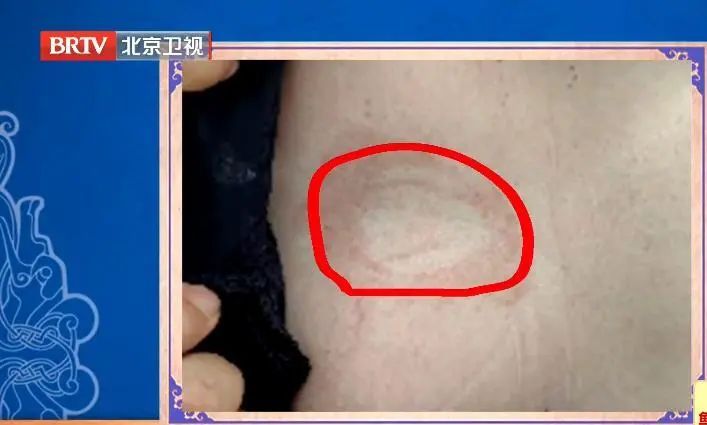 提醒!关于爆火的“三伏贴” 这些事项需要知道→_北京时间