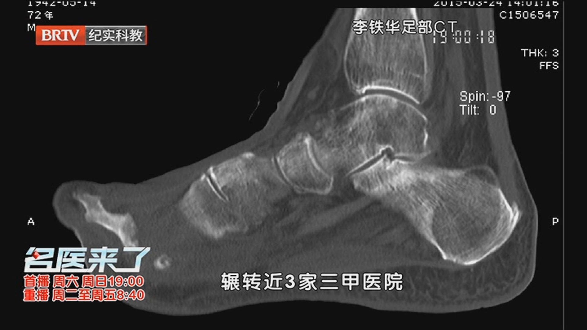《名医来了》20251122中西医携手护糖足