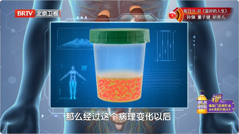 蛋白尿既是糖肾的临床表现,也是损伤肾脏的“毒药” 蛋白尿既是糖肾的临床表现,也是损伤肾脏的“毒药”