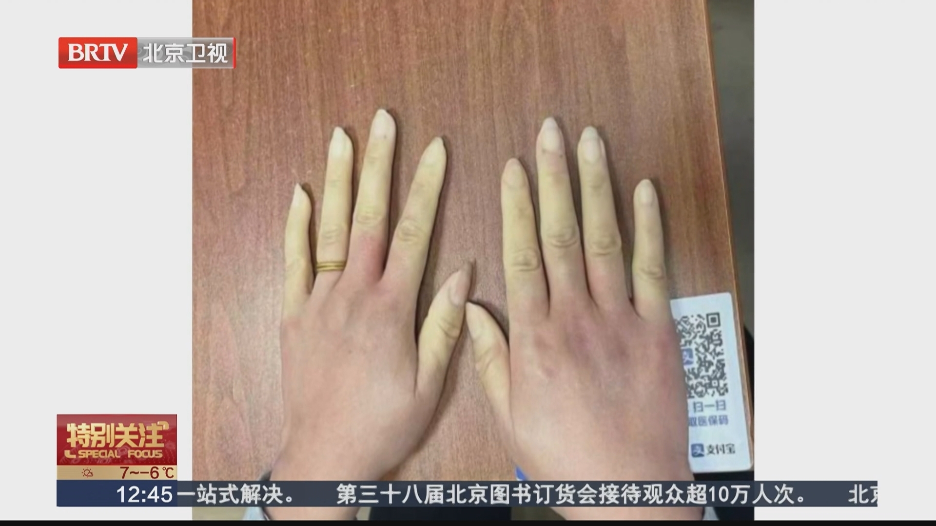 一入冬手指就发白变紫 可能是风湿病的信号